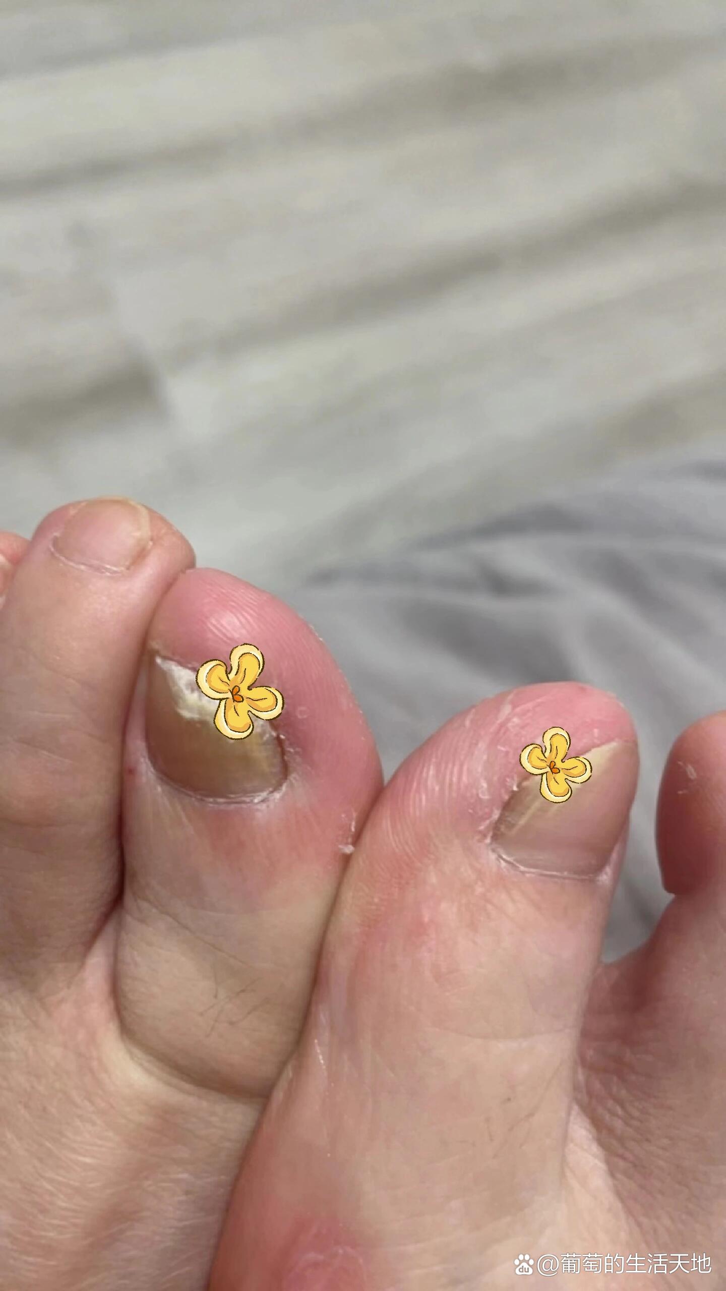几年前不知什么原因,两个大脚趾开始增厚发黄,里面还有很多白色粉粉