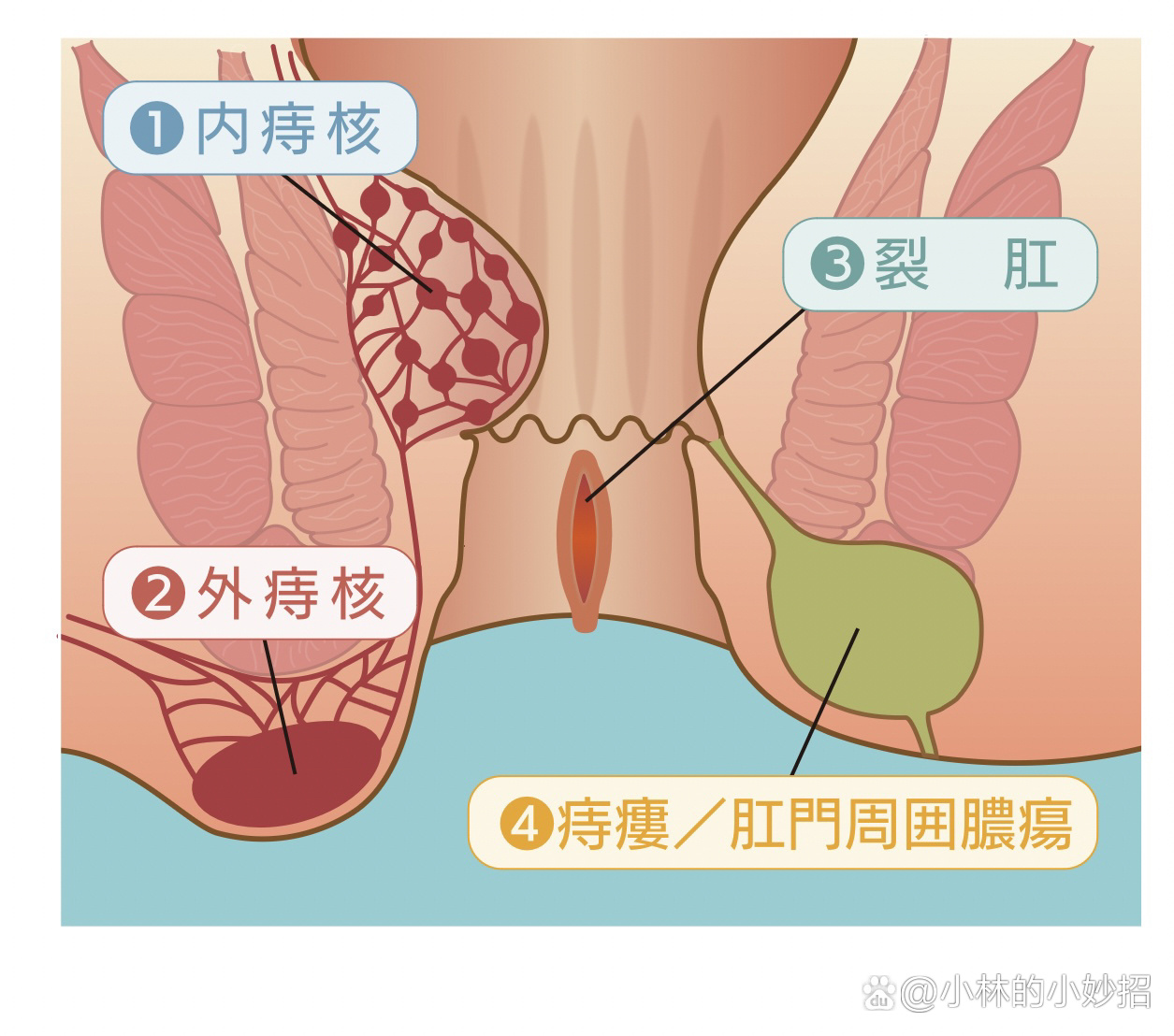 痔疮在什么位置图片图片