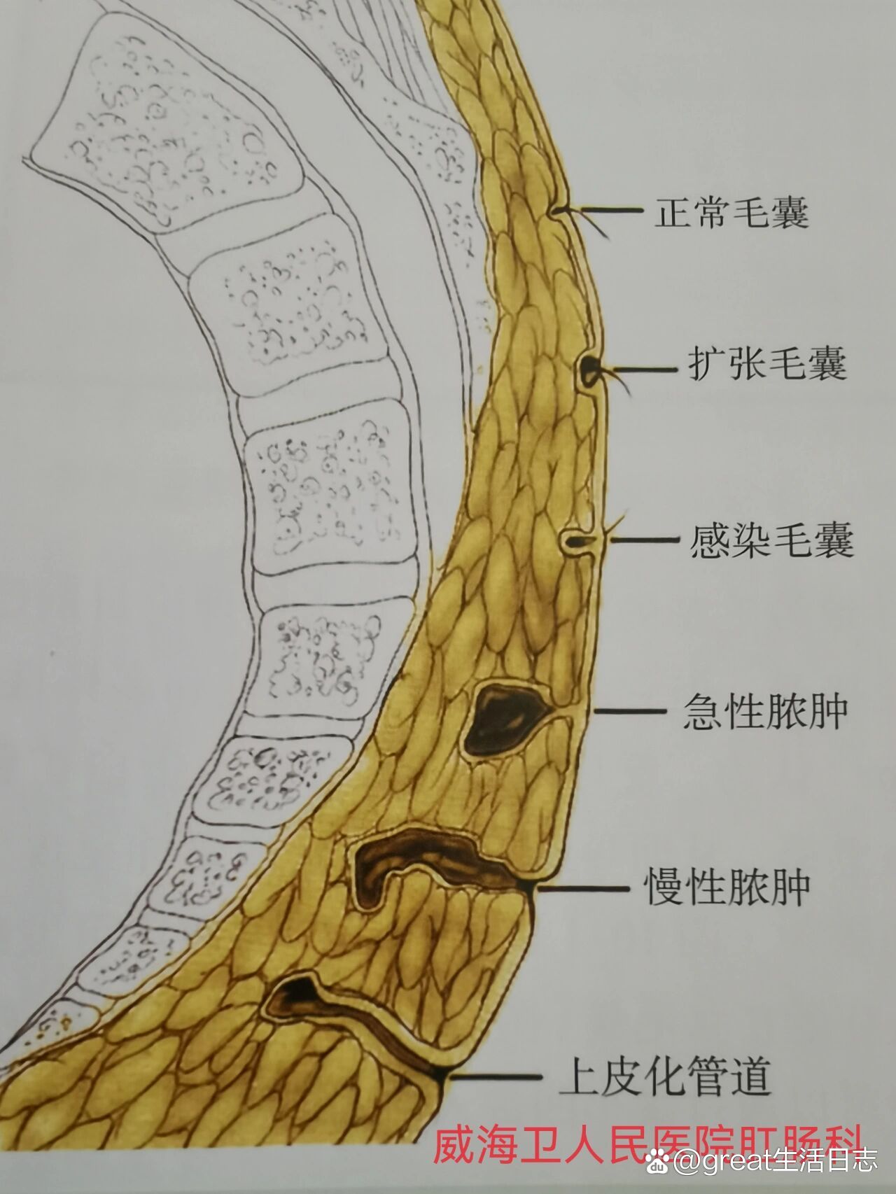 藏毛窦是怎么形成的图片