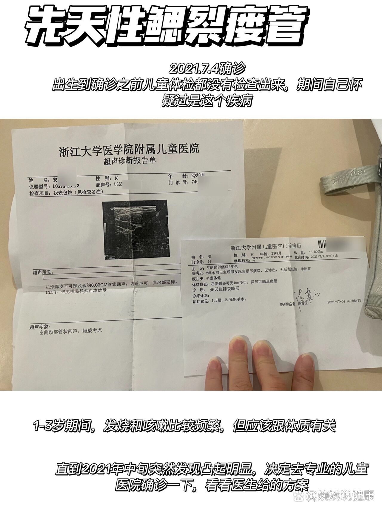 先天性鳃裂瘘管