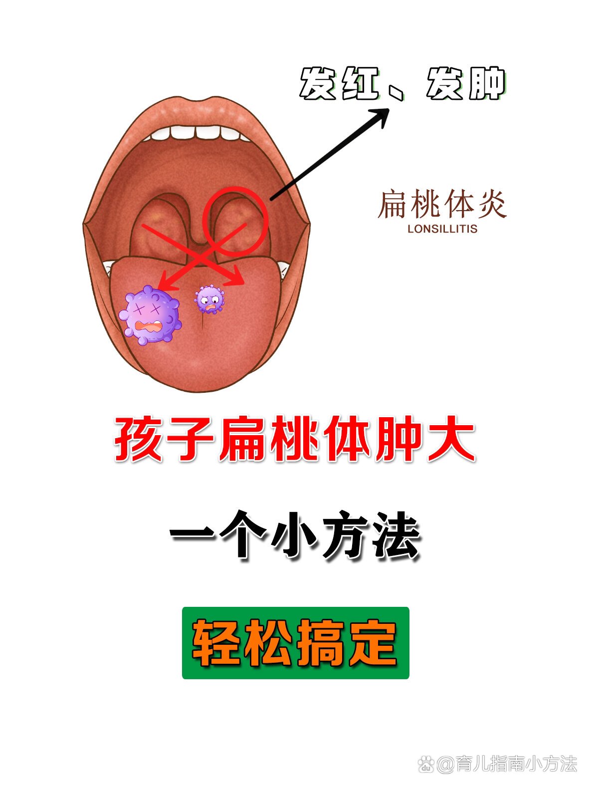 孩子扁桃体息肉图片图片