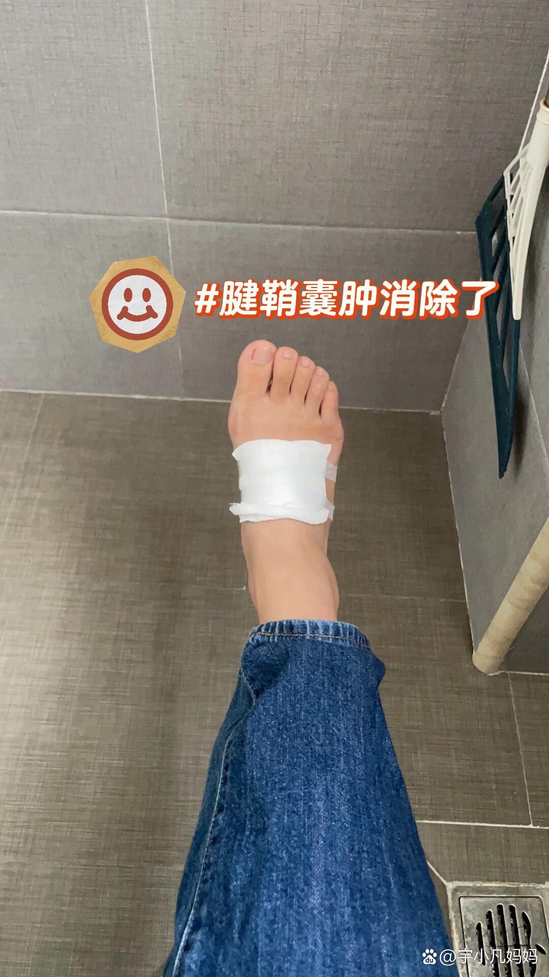  p>#腱鞘囊肿50元搞定 br>脚背上的腱鞘囊肿长了四五年了,刚开始还