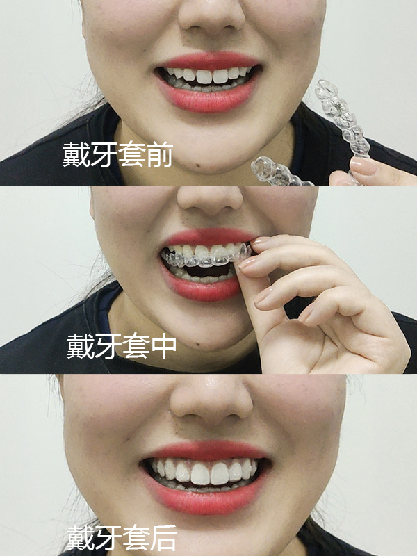 隐形牙套的佩戴过程