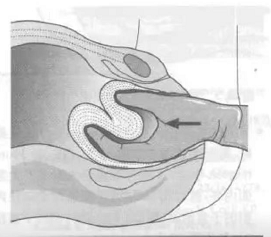 子宫内翻的病因和治疗