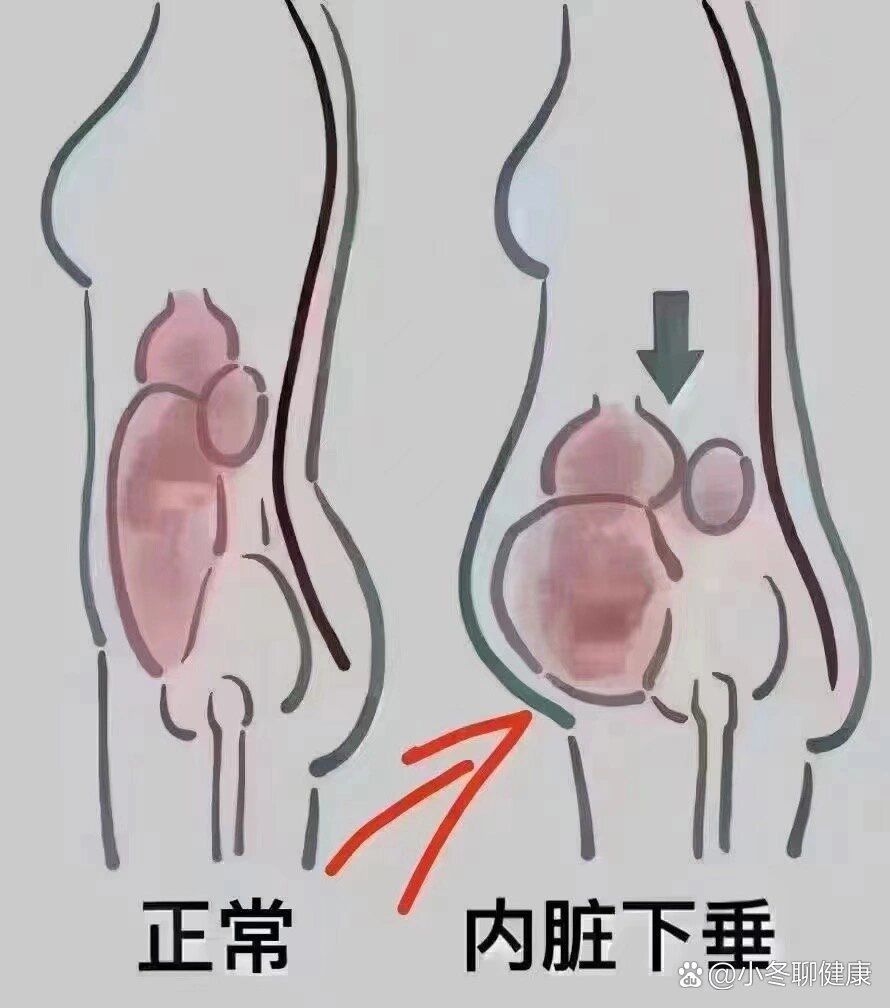 骨盆前倾小腹凸起照片图片