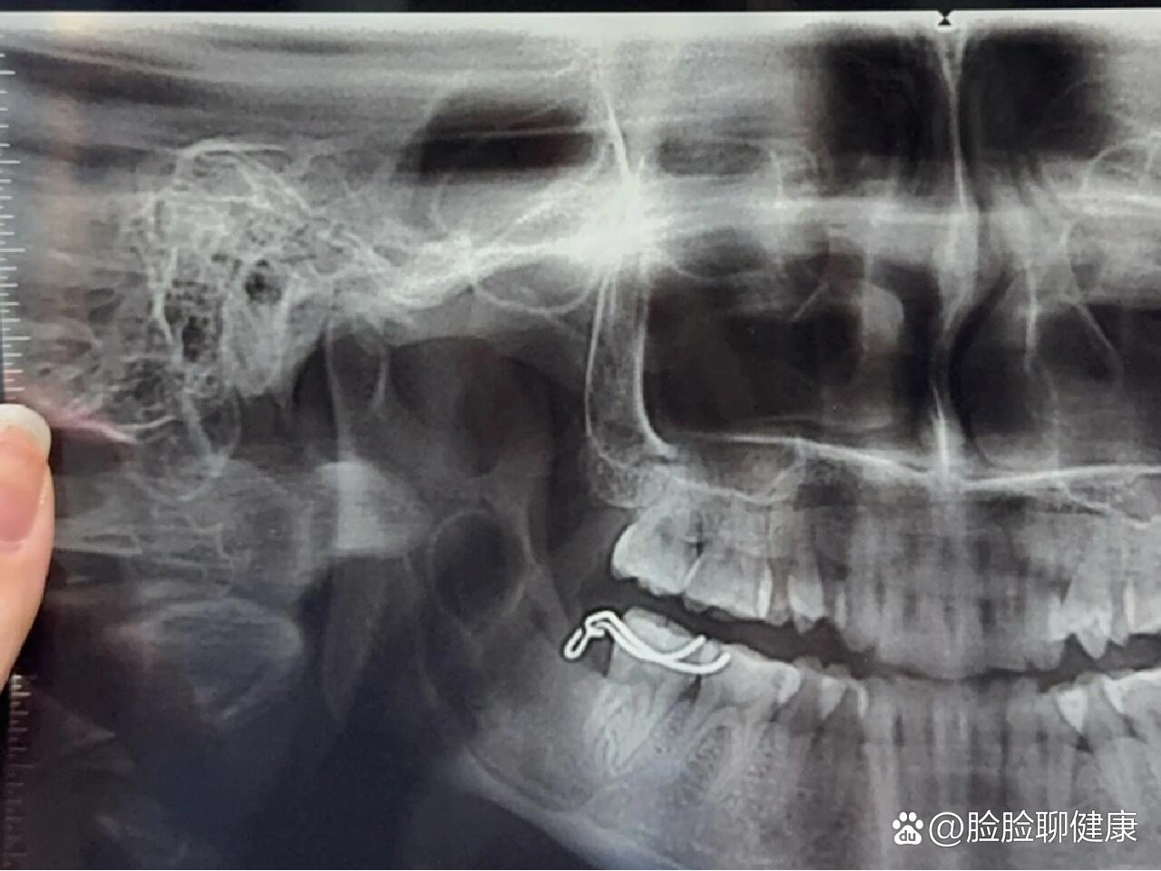 下颌骨ct平扫图片