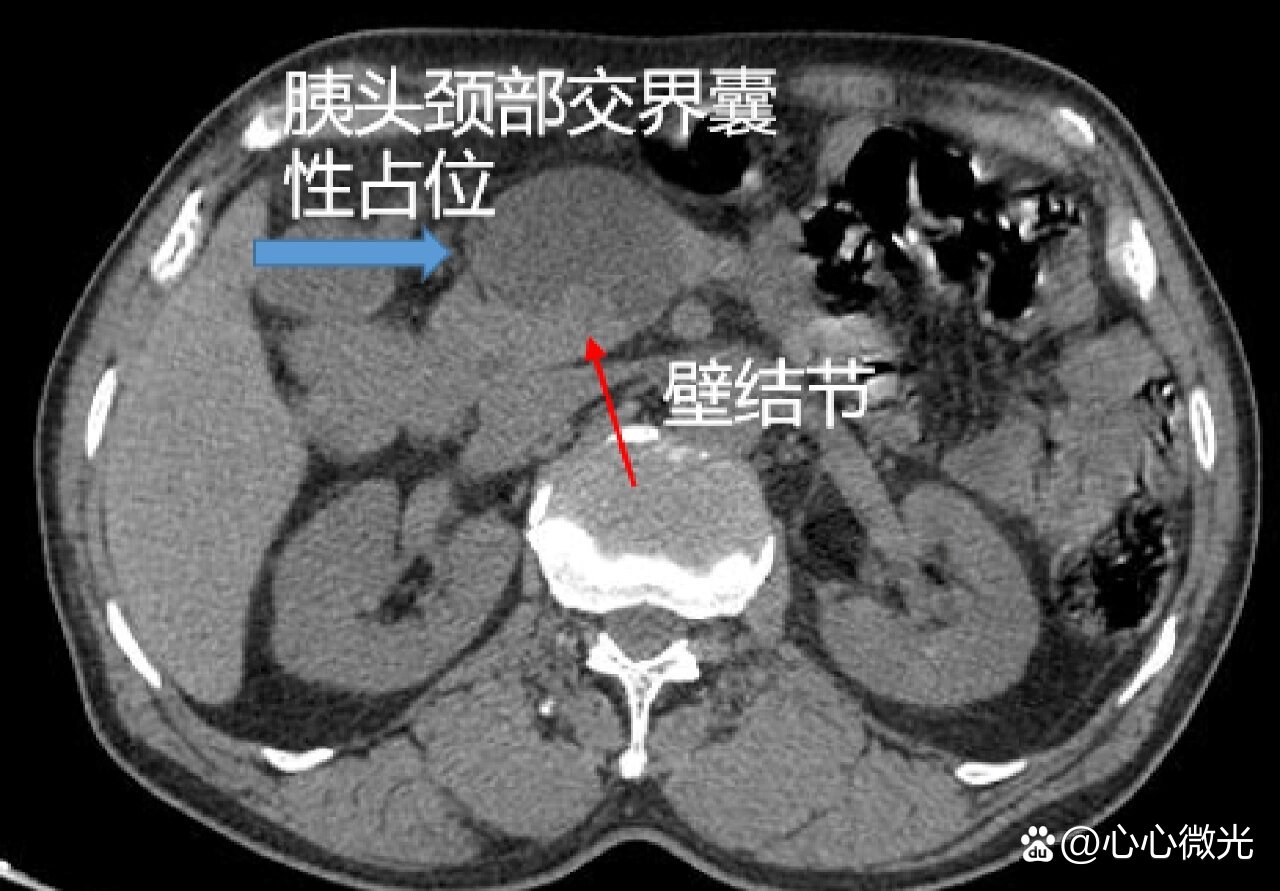 胰腺结节图片