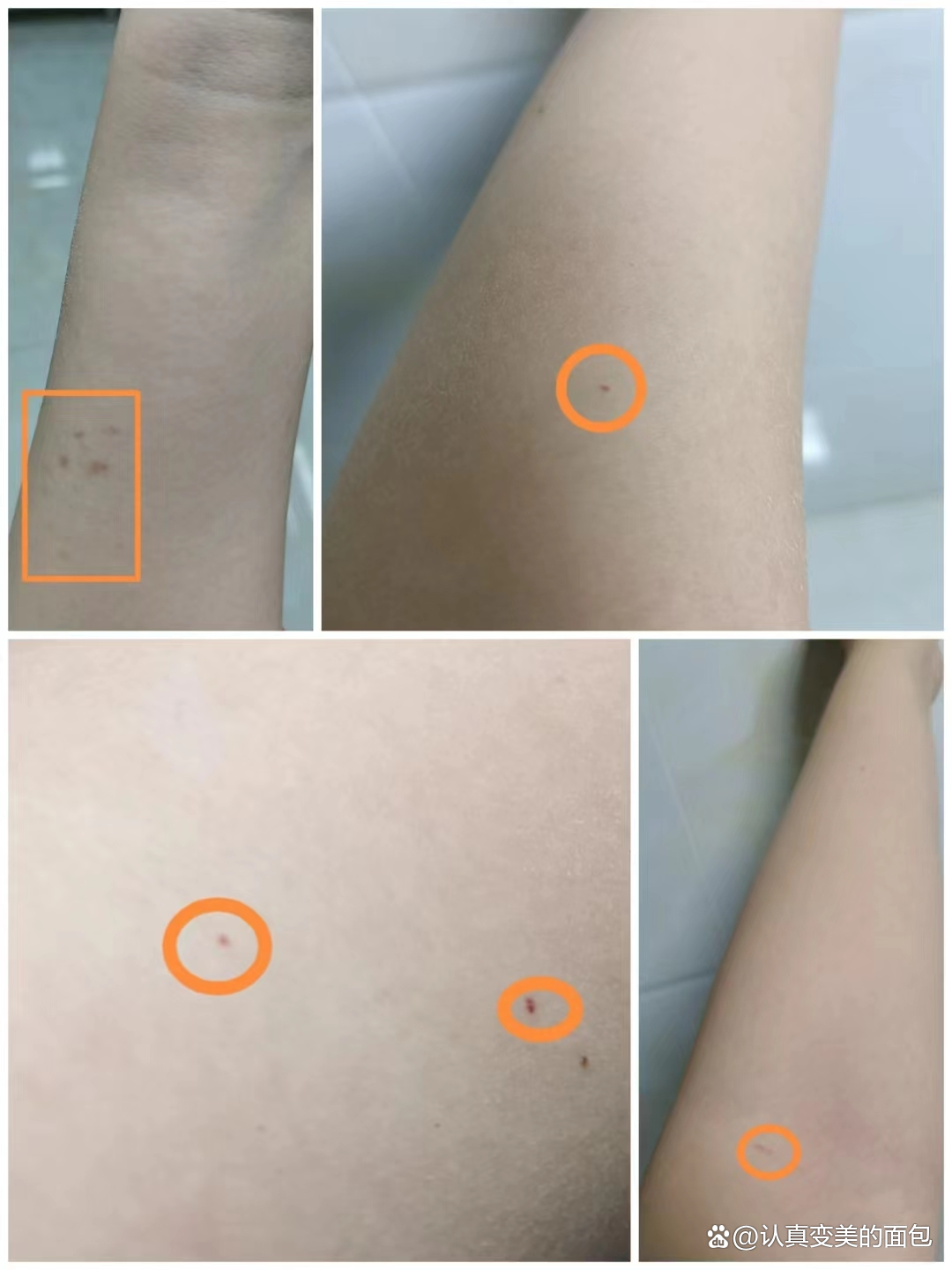 血管痣主要是先天发育不良,导致血管出现扩张增生.