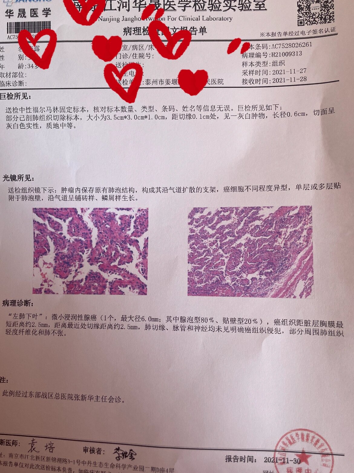 微浸润腺癌图片