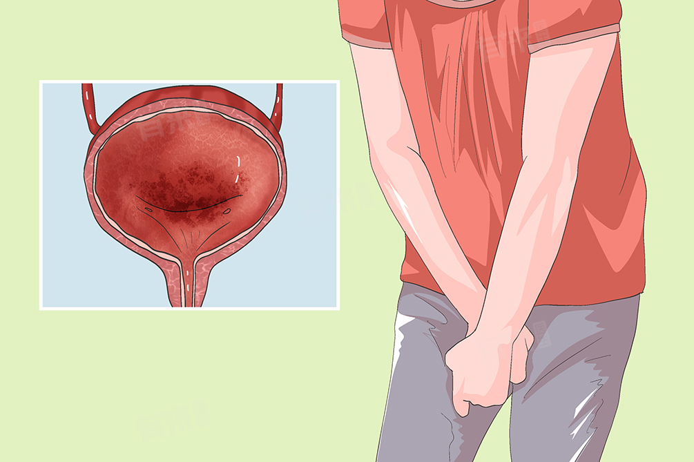 膀胱炎早期是什么症状表现