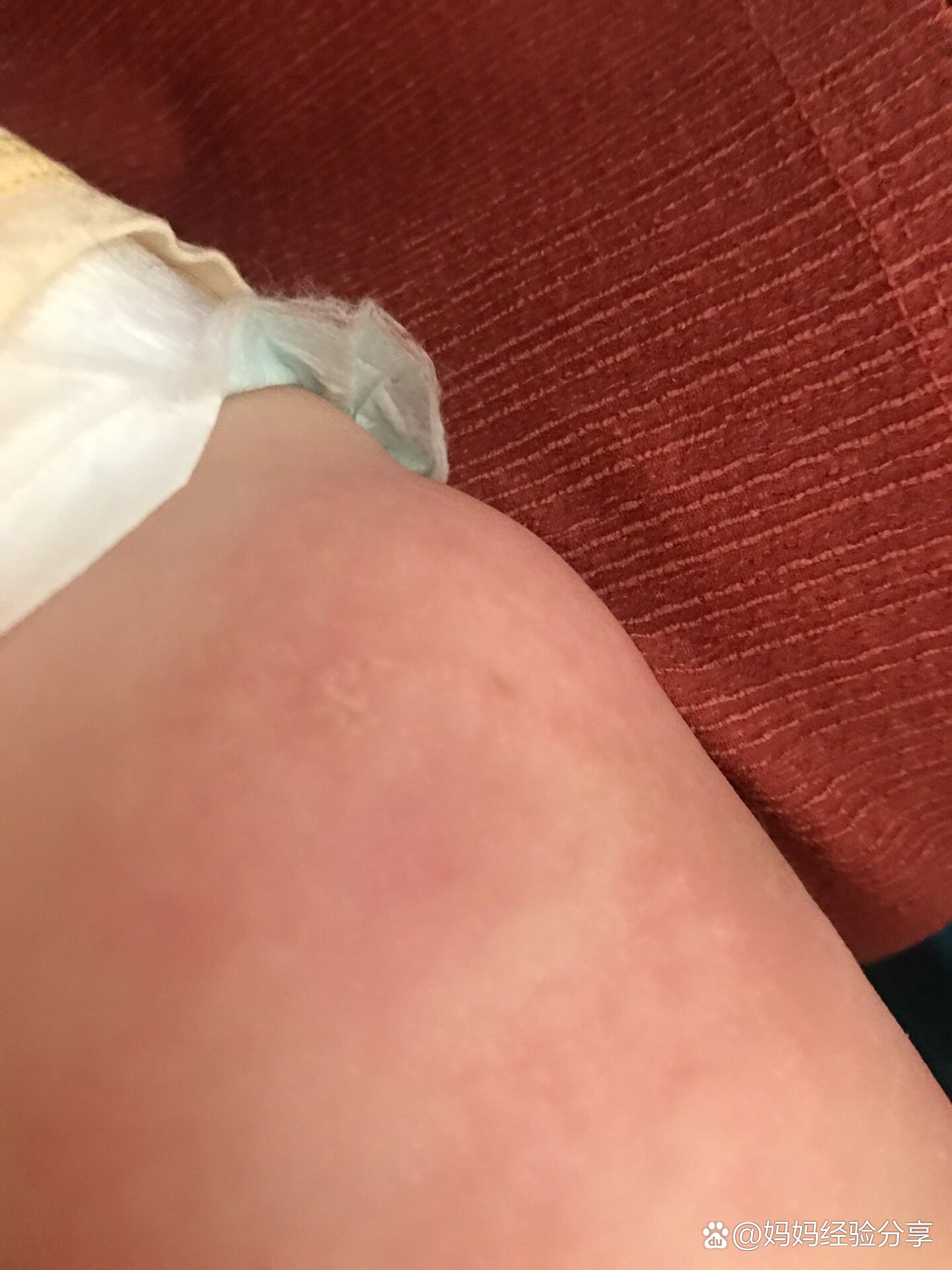 宝宝打疫苗后出现红肿硬块