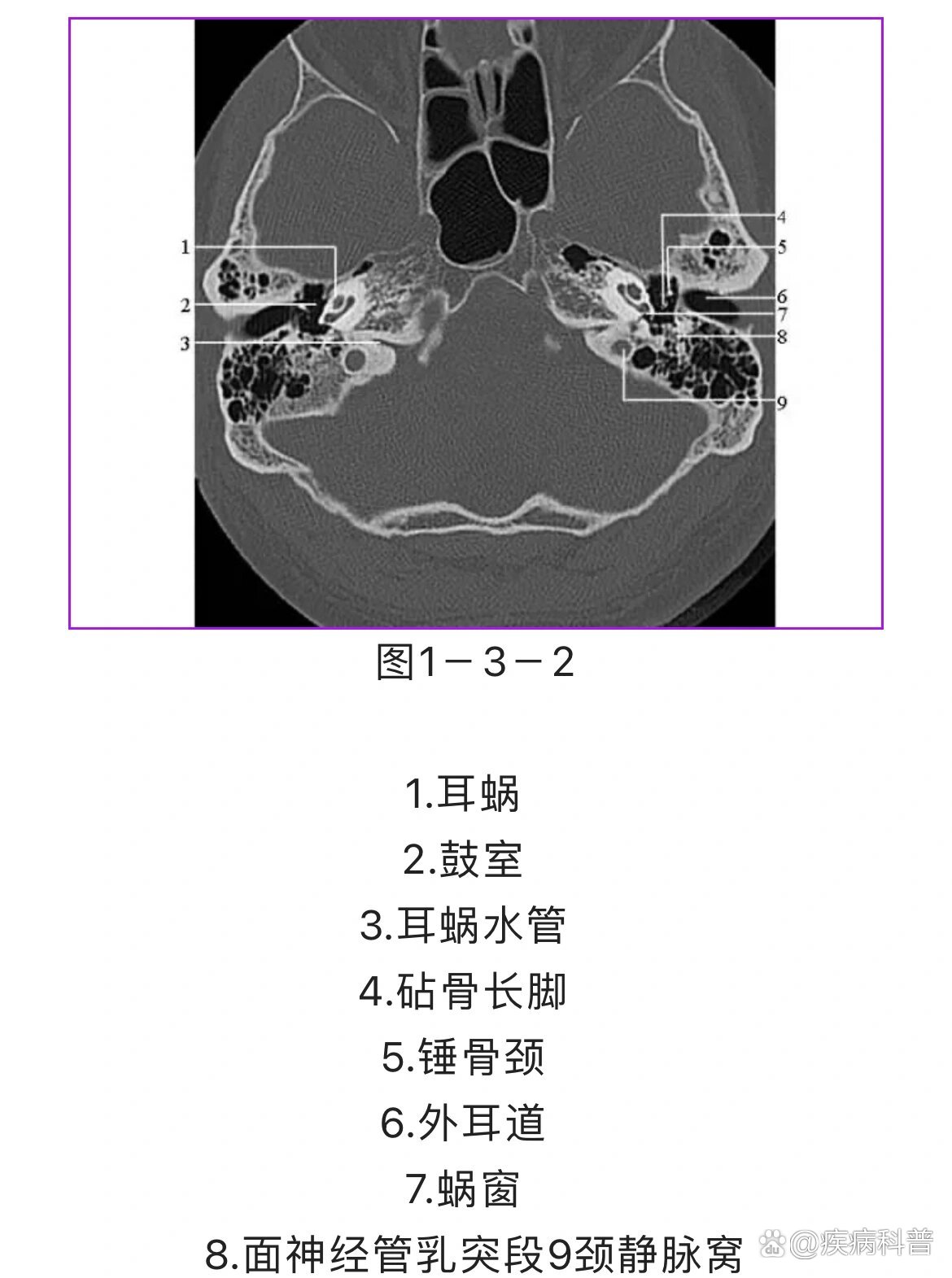 影像学干货|颞骨ct解剖(轴位)