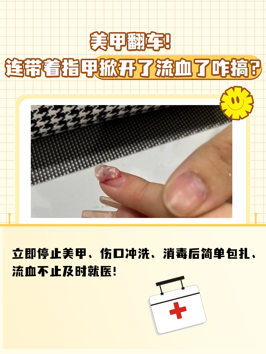 美甲翻车!连带着指甲掀开了流血了咋搞?