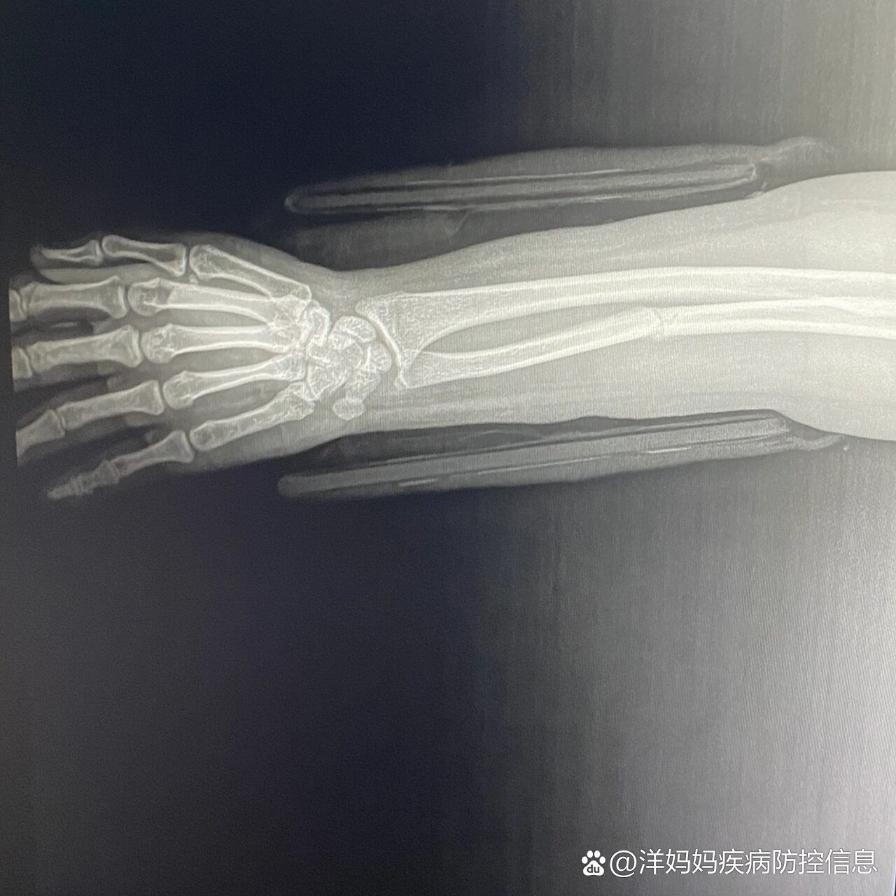 中断骨折第53天接骨保守治疗的,今天第53天,第一个张最近的片子
