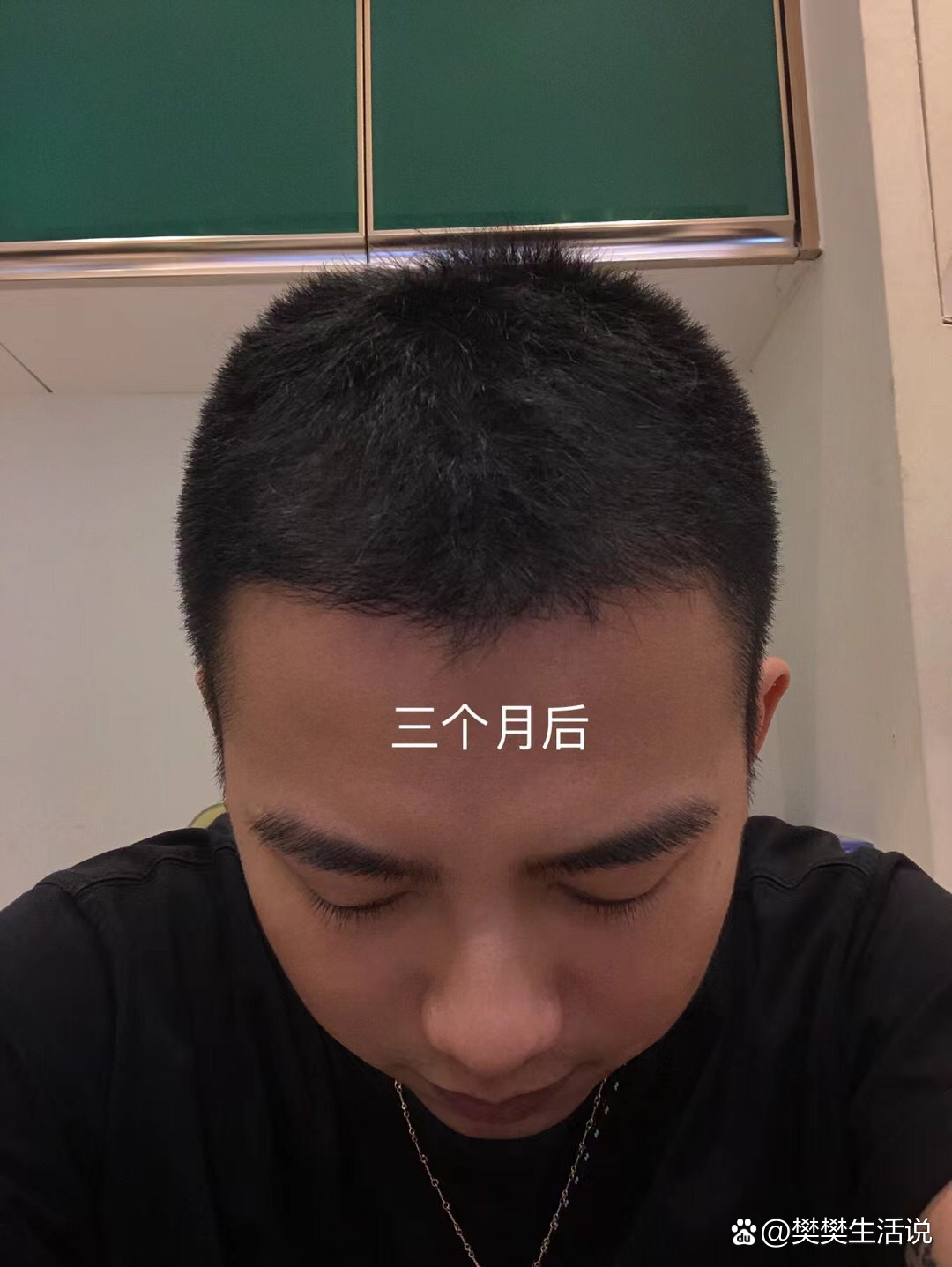 植发去哪里植发最好(植发一般去哪里比较好)