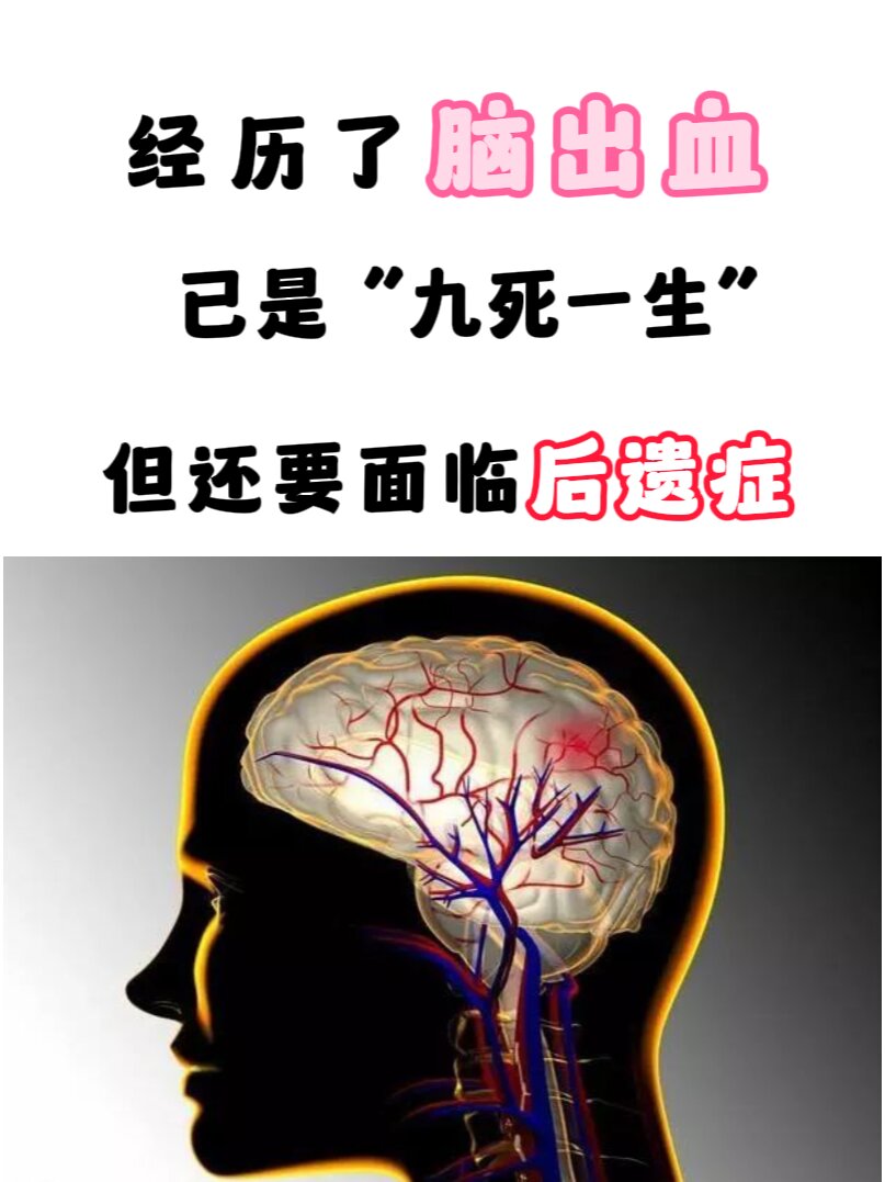 脑出血的5大后遗症,其实也可以好的