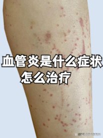 血管炎是什么症状，怎么治疗