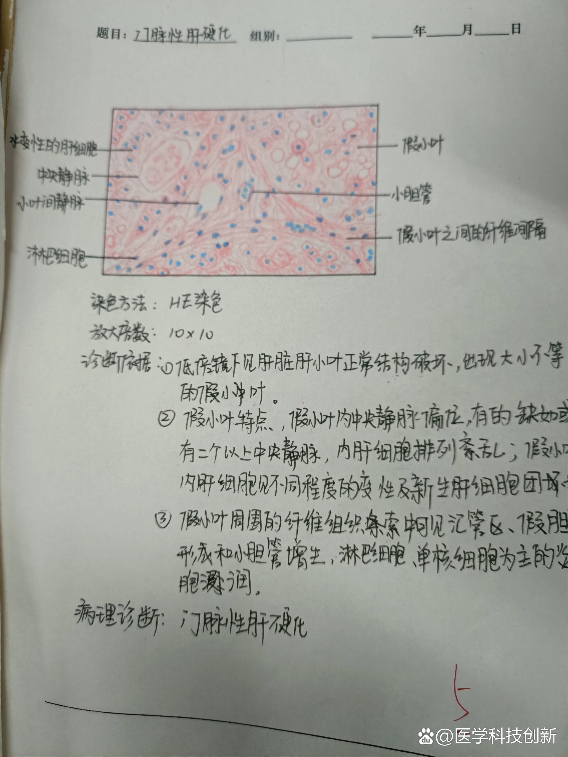 肝硬化手绘图实验报告图片