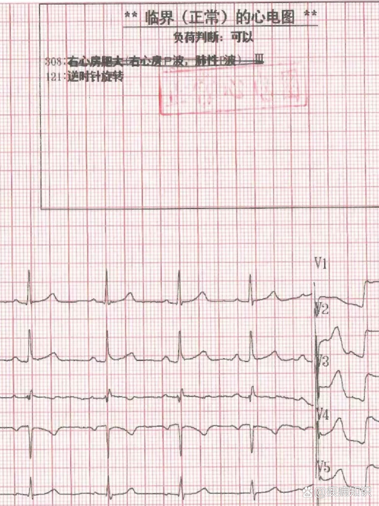 右心房肥大的心电图图片