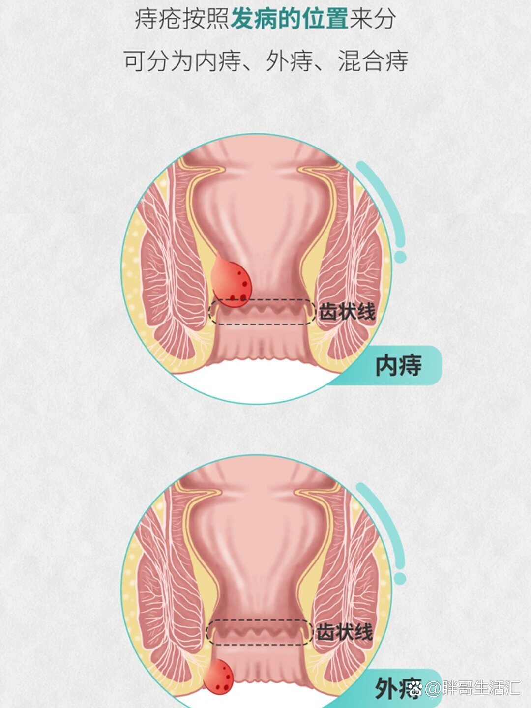 痔疮概念图图片