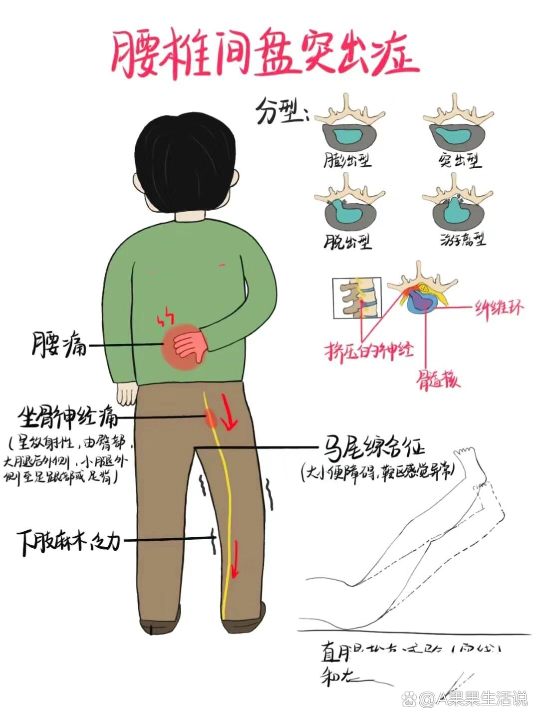 终于找到了鉴别腰痛类型的方法?