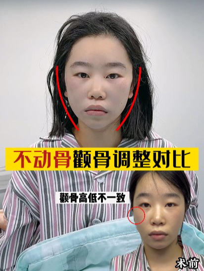 左右脸不对称,微创不动骨调整术后