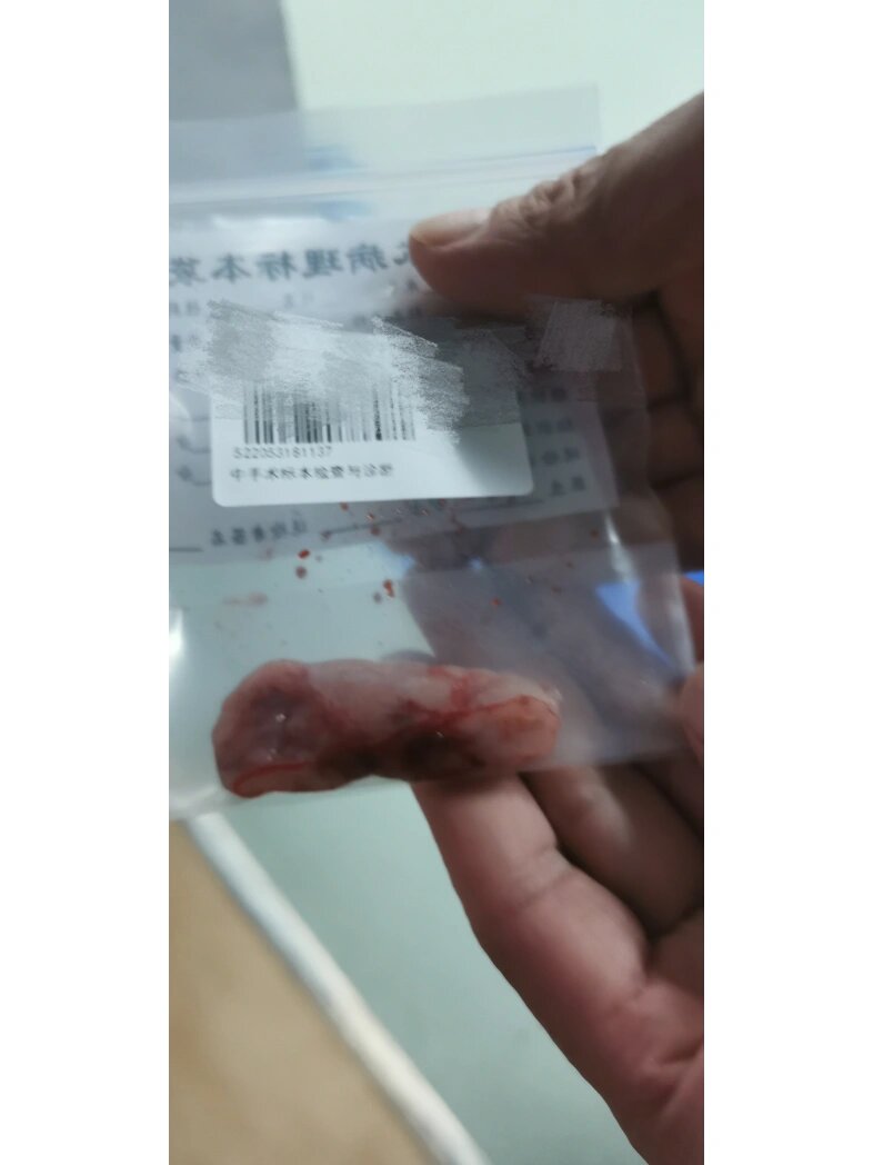 椎管内肿瘤成功切除