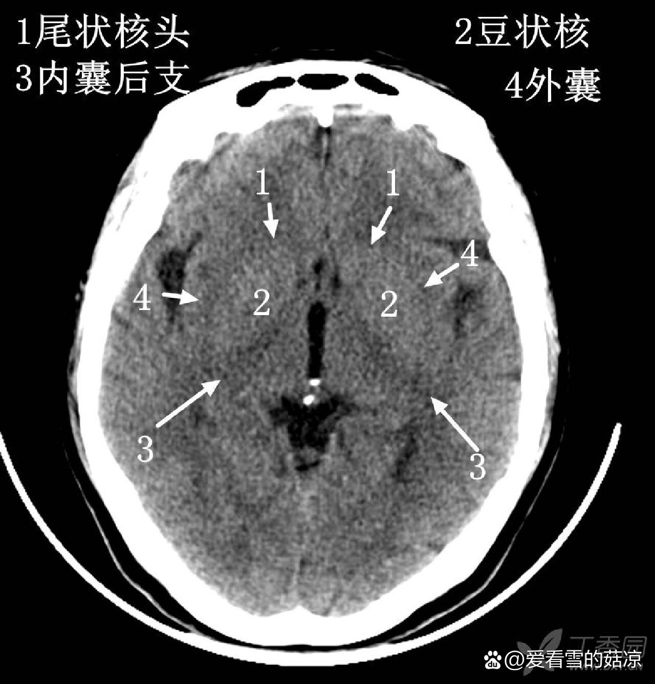 基底节区影像图片图片