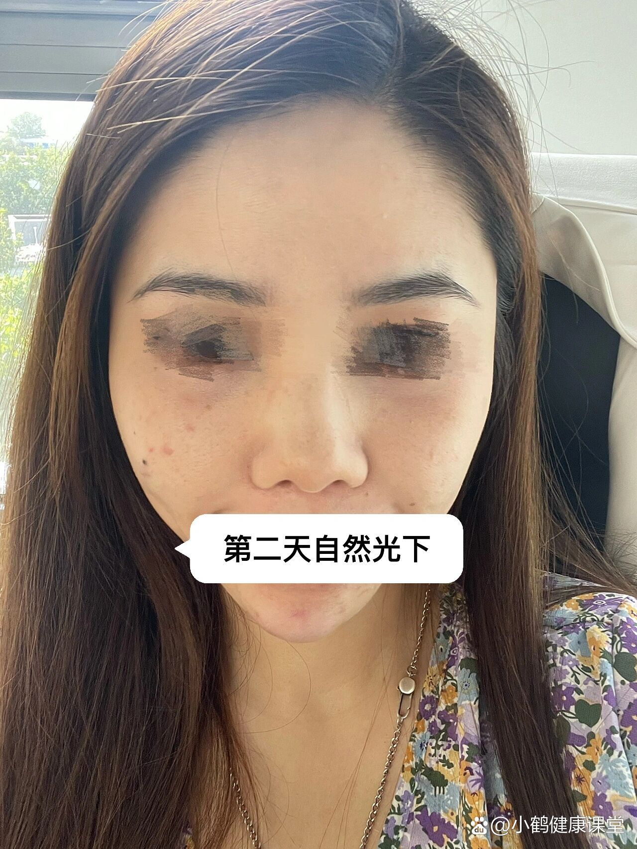 关于溶解酶溶解玻尿酸泪沟恢复第二天