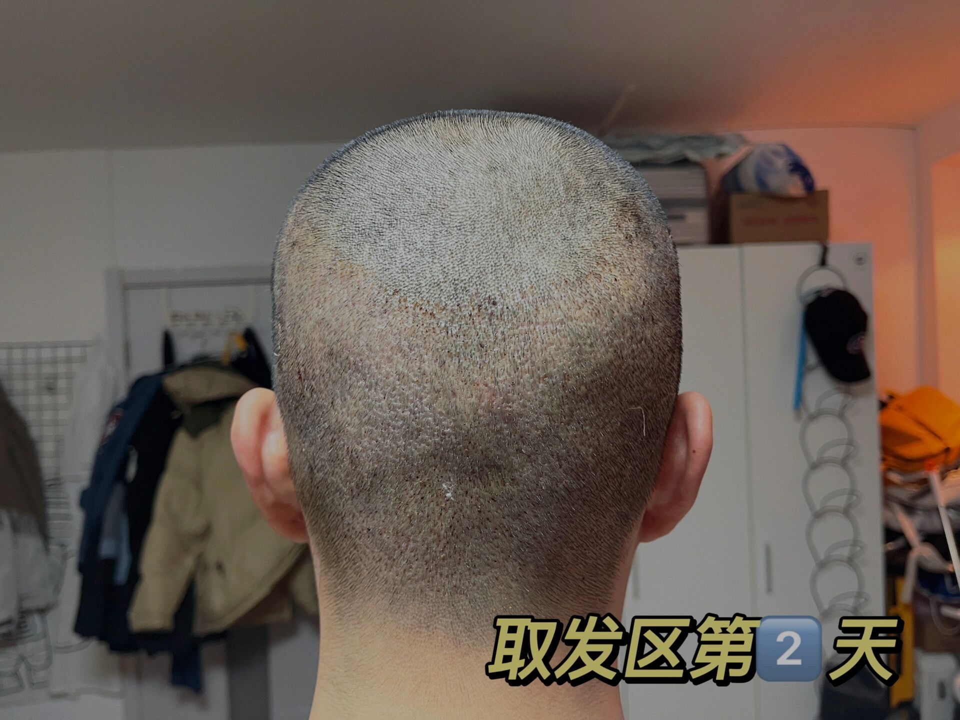 植发取发区秃了怎么办(植发后取发区出现斑秃正常吗)