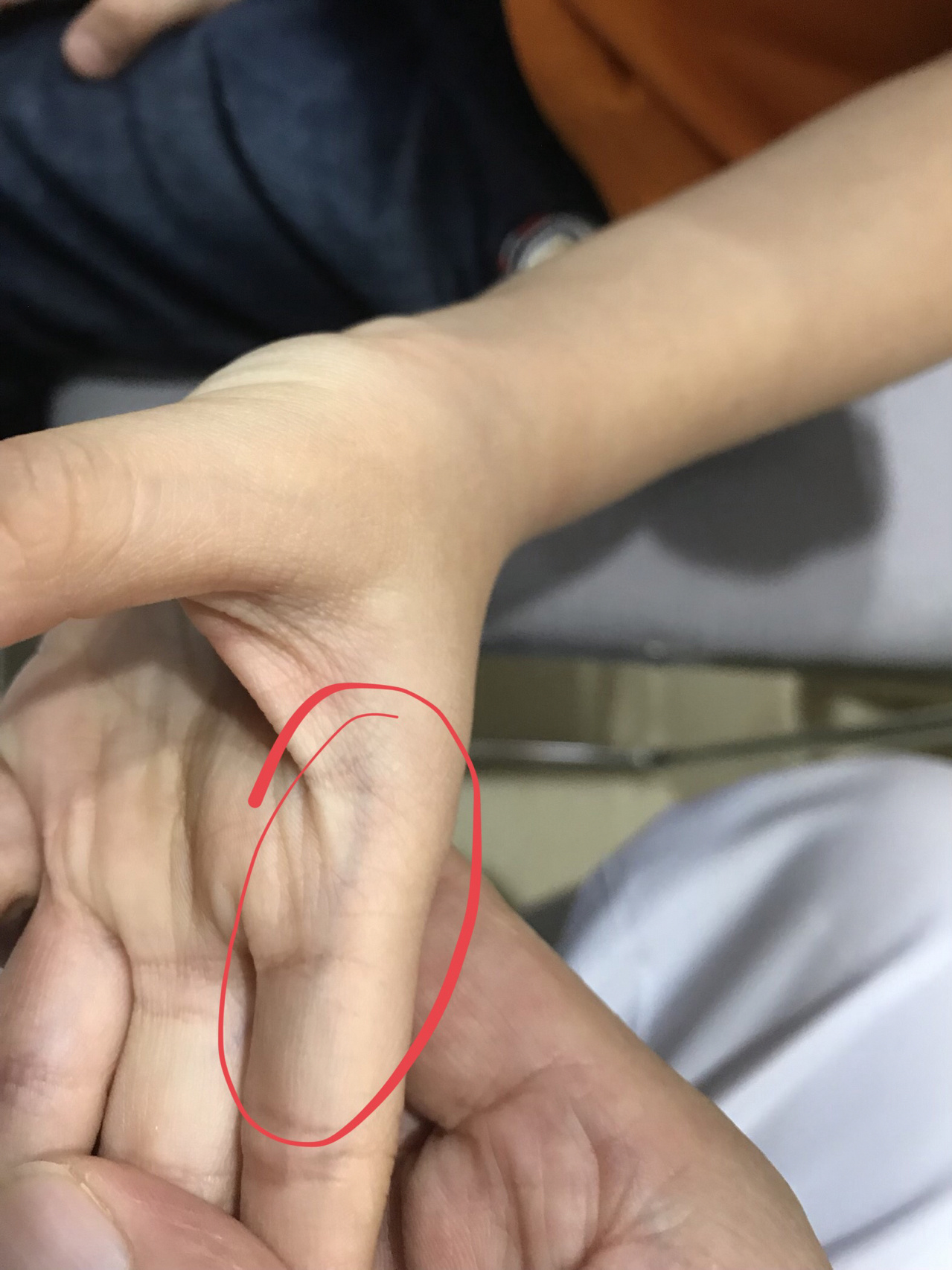 小儿指纹色紫红,家长要当心