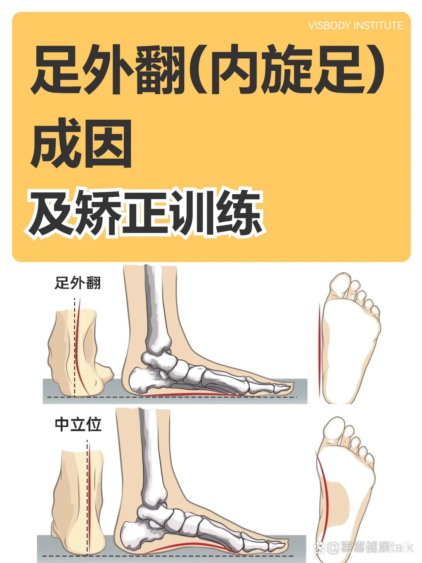 足踝外翻矫正方法图片