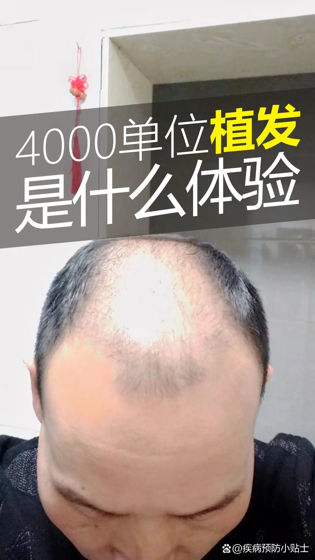 500个毛囊植发面积图图片