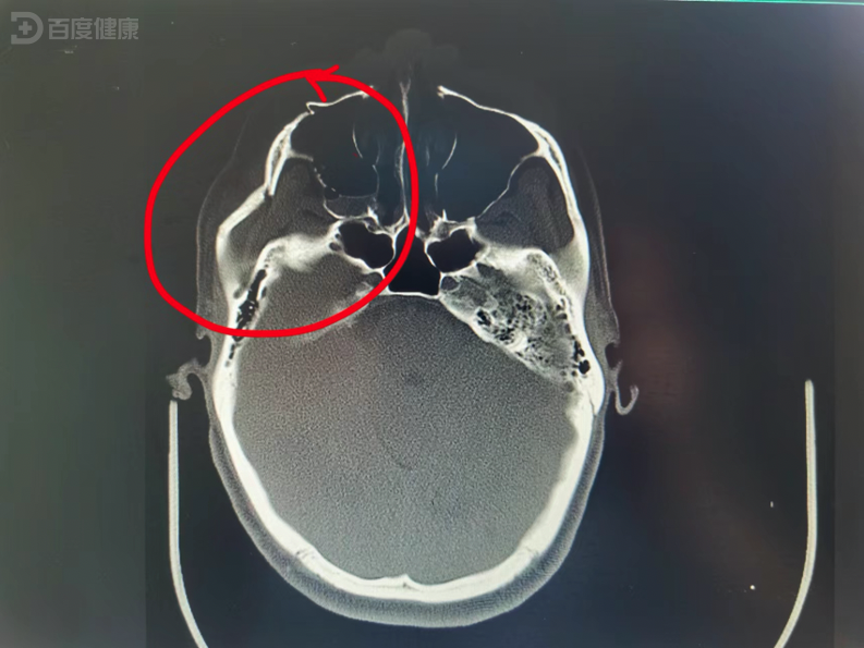 颧骨ct图片