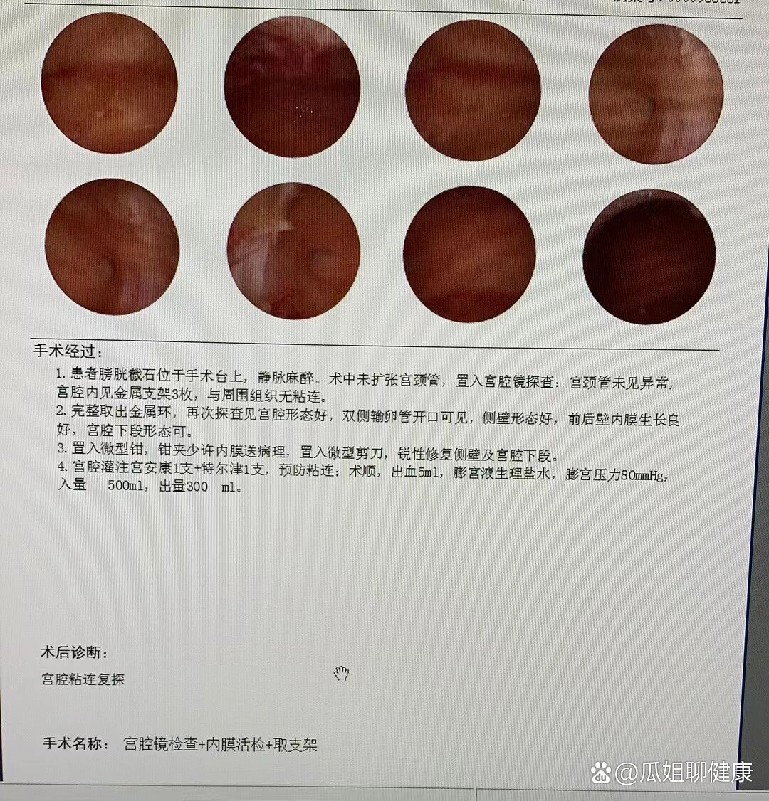 有没有姐妹取环后出血00量大的