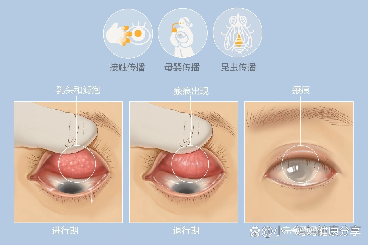 沙眼能治好吗 全网资源
