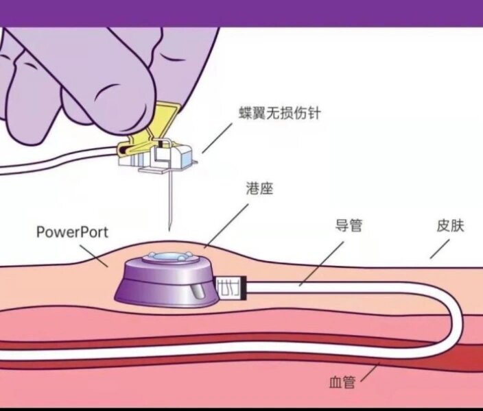 输液港维护针头图片