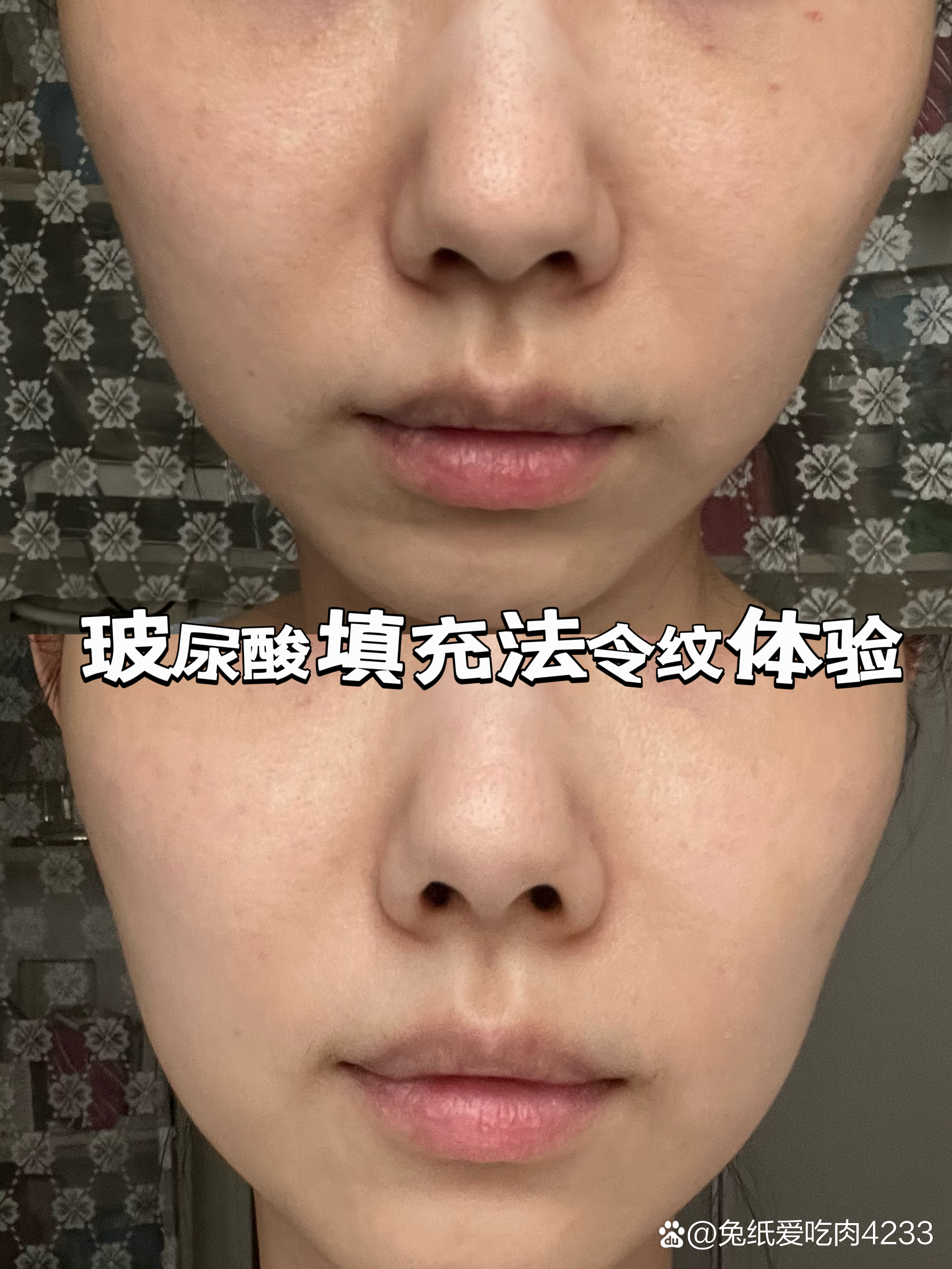 玻尿酸填充法令纹体验