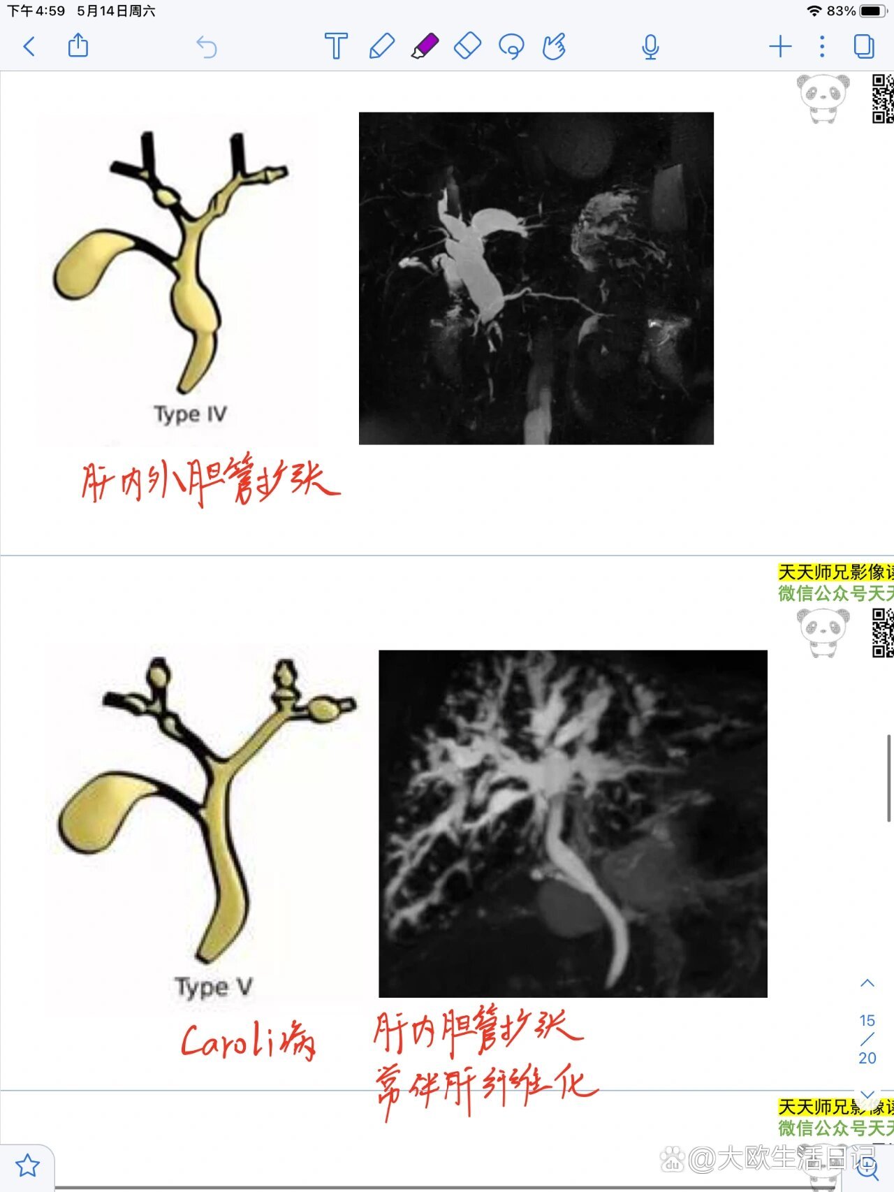 先天性胆管扩张的五种类型