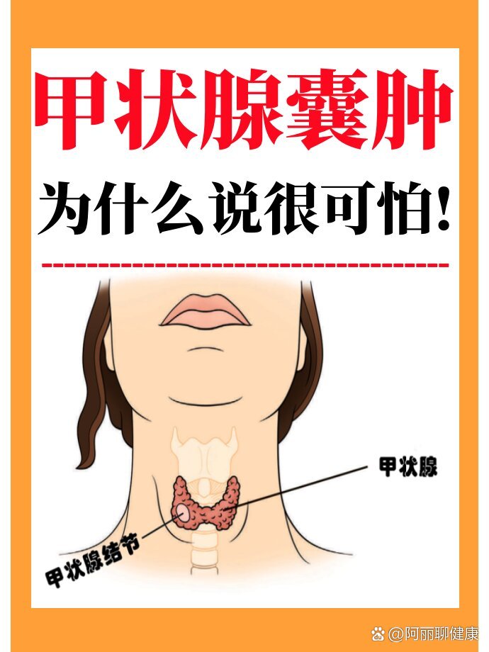  br>甲状腺囊肿是甲状腺结节中的一种,是比较常见的甲状腺良性疾病.