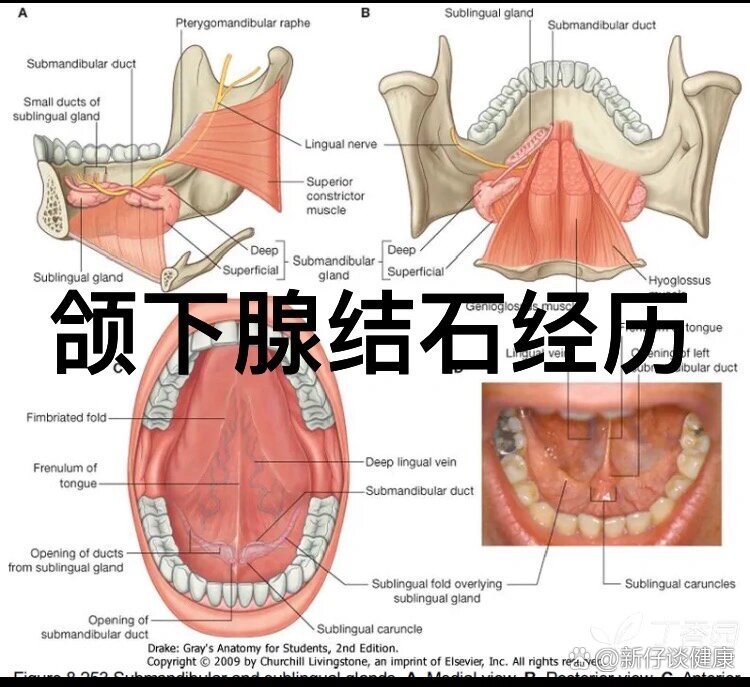 分享记录一下奇特的颌下腺结石经历