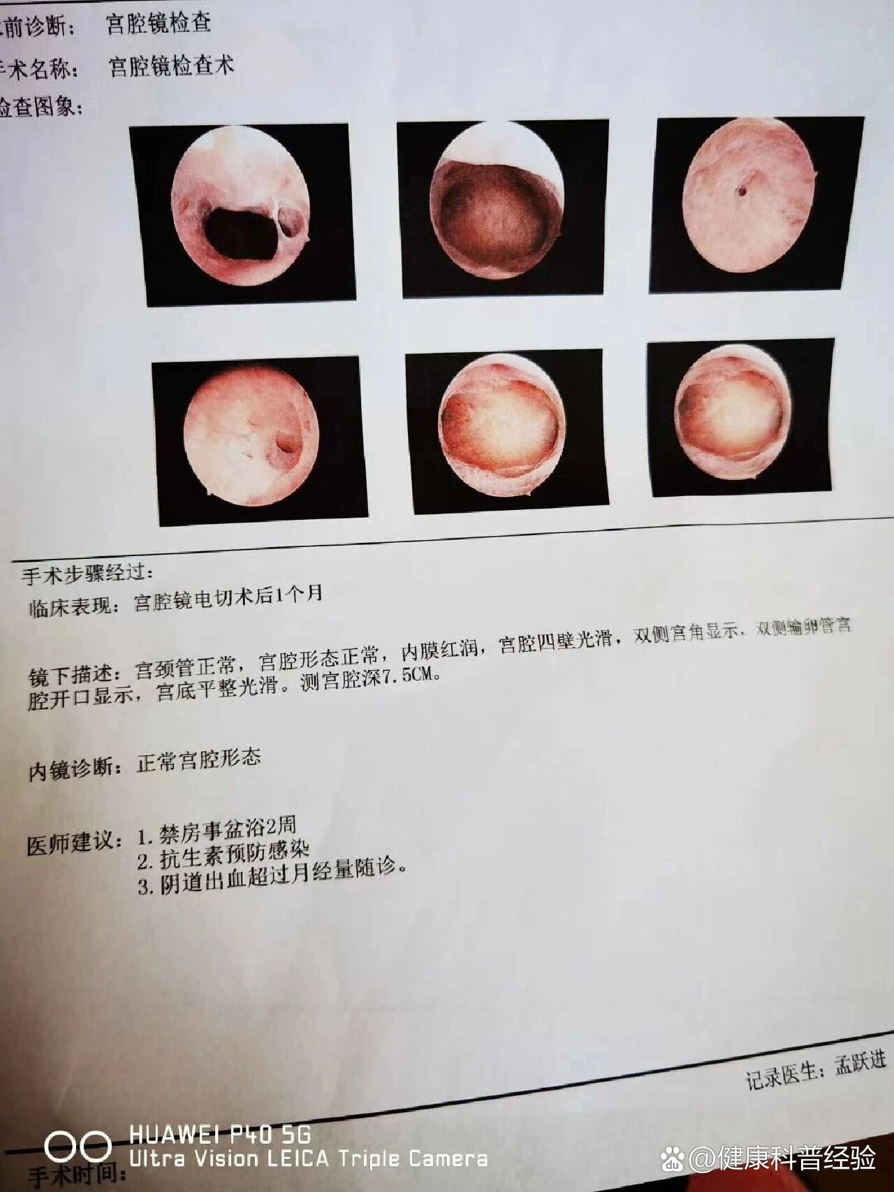 十个宫腔镜九个内膜炎图片