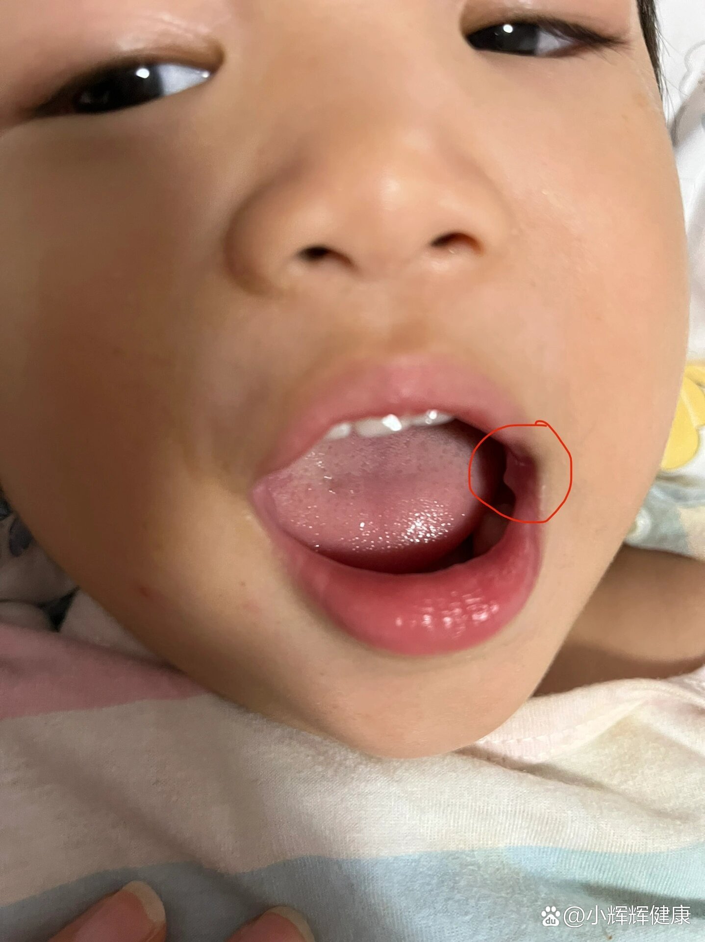 宝宝口腔内两侧长得小疙瘩,这是啥啊?