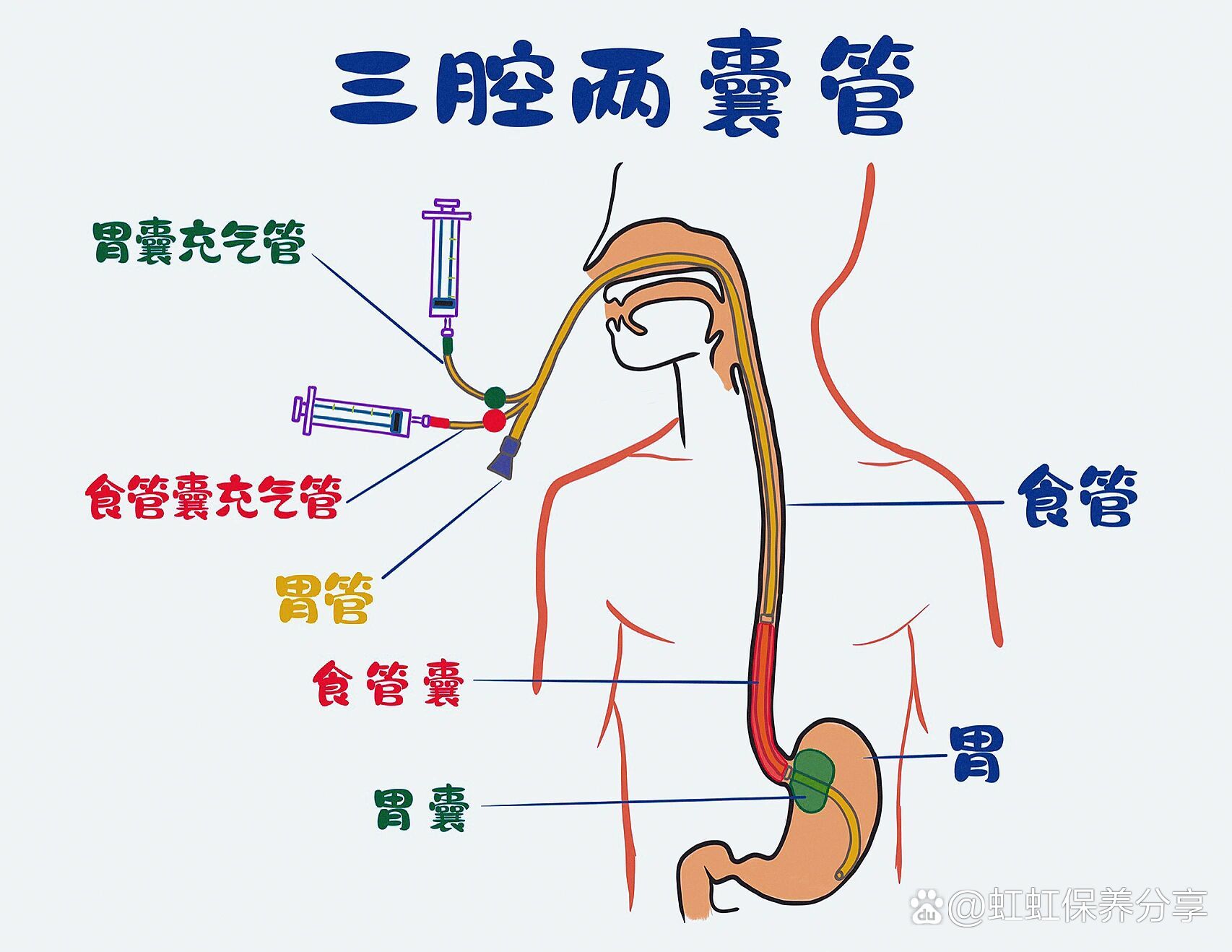 三腔二囊管胃管注气图片