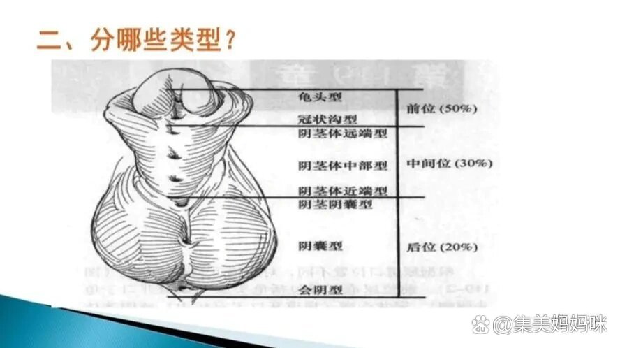 宝宝尿道下裂怎么办