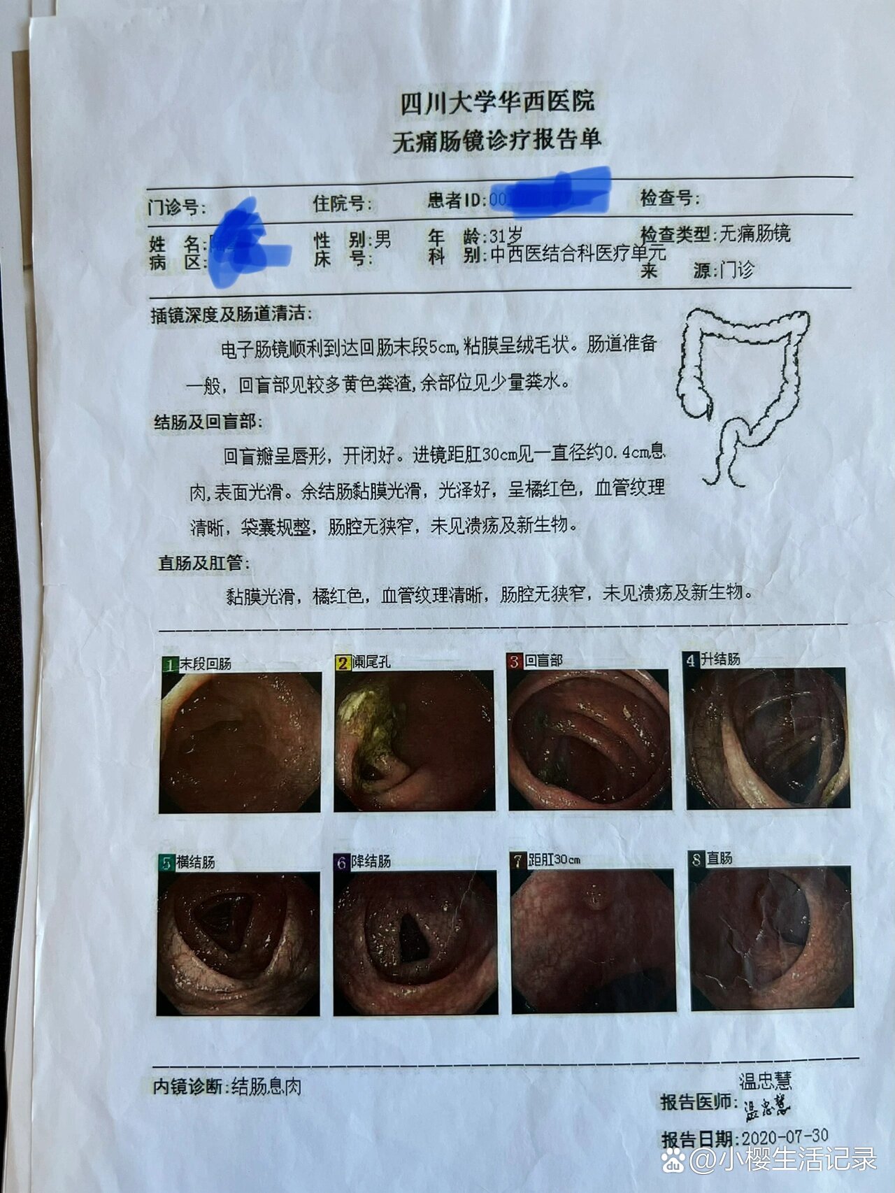 结肠广基息肉0.6cm后续-住院切除