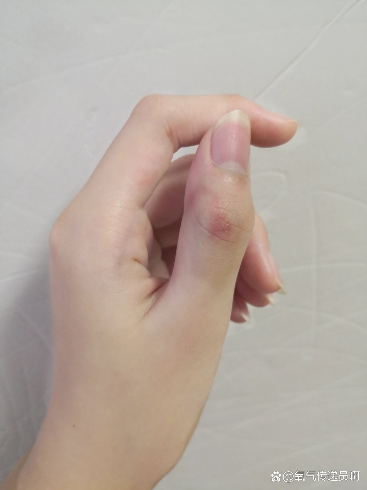 然后又慢慢变肿了,关节处关弯不了,吓得我赶紧去正骨,很好,太好了,好