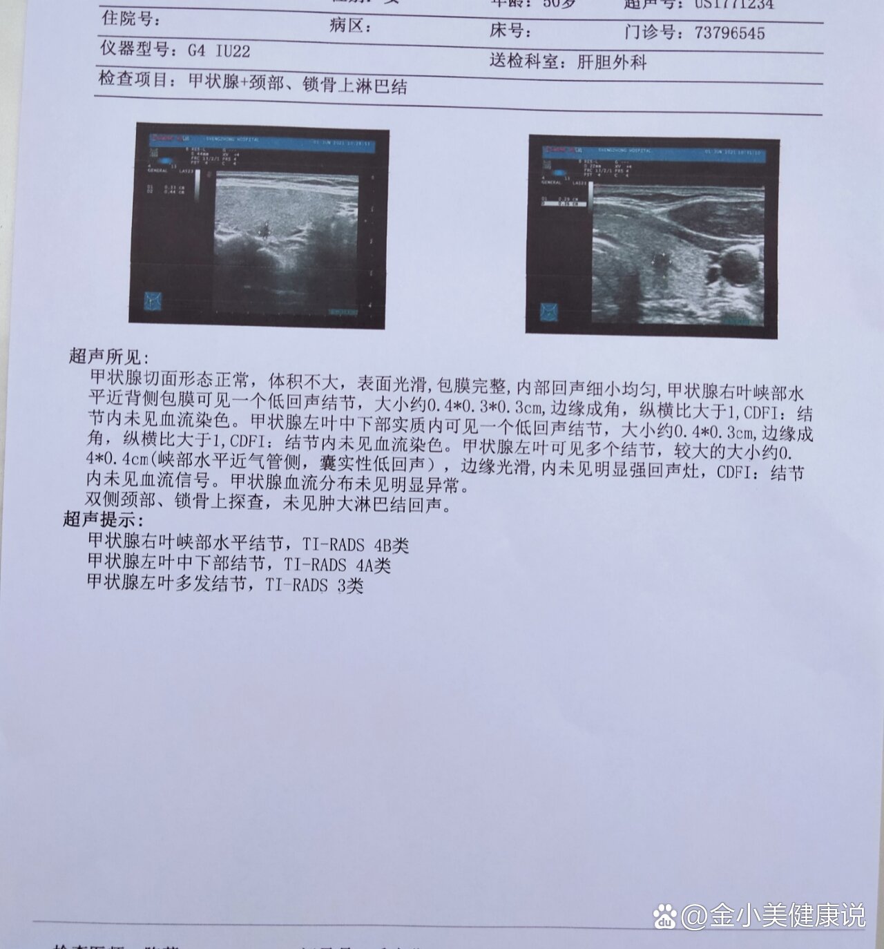 甲状腺结节恶变信号图片