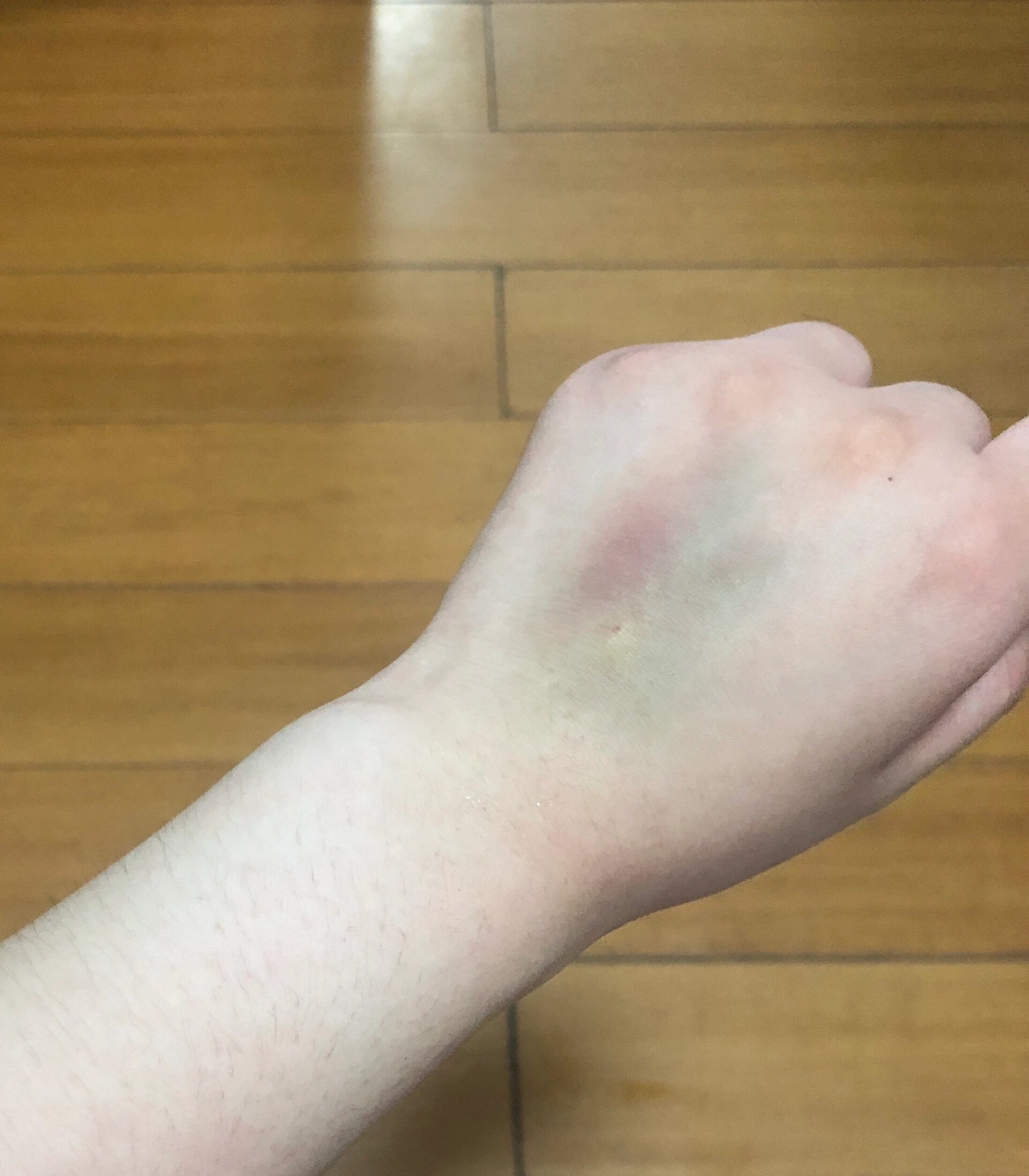  p>吊水已经过了九天了 手背还是青的 br>谁懂呀像僵尸手一样 一碰还