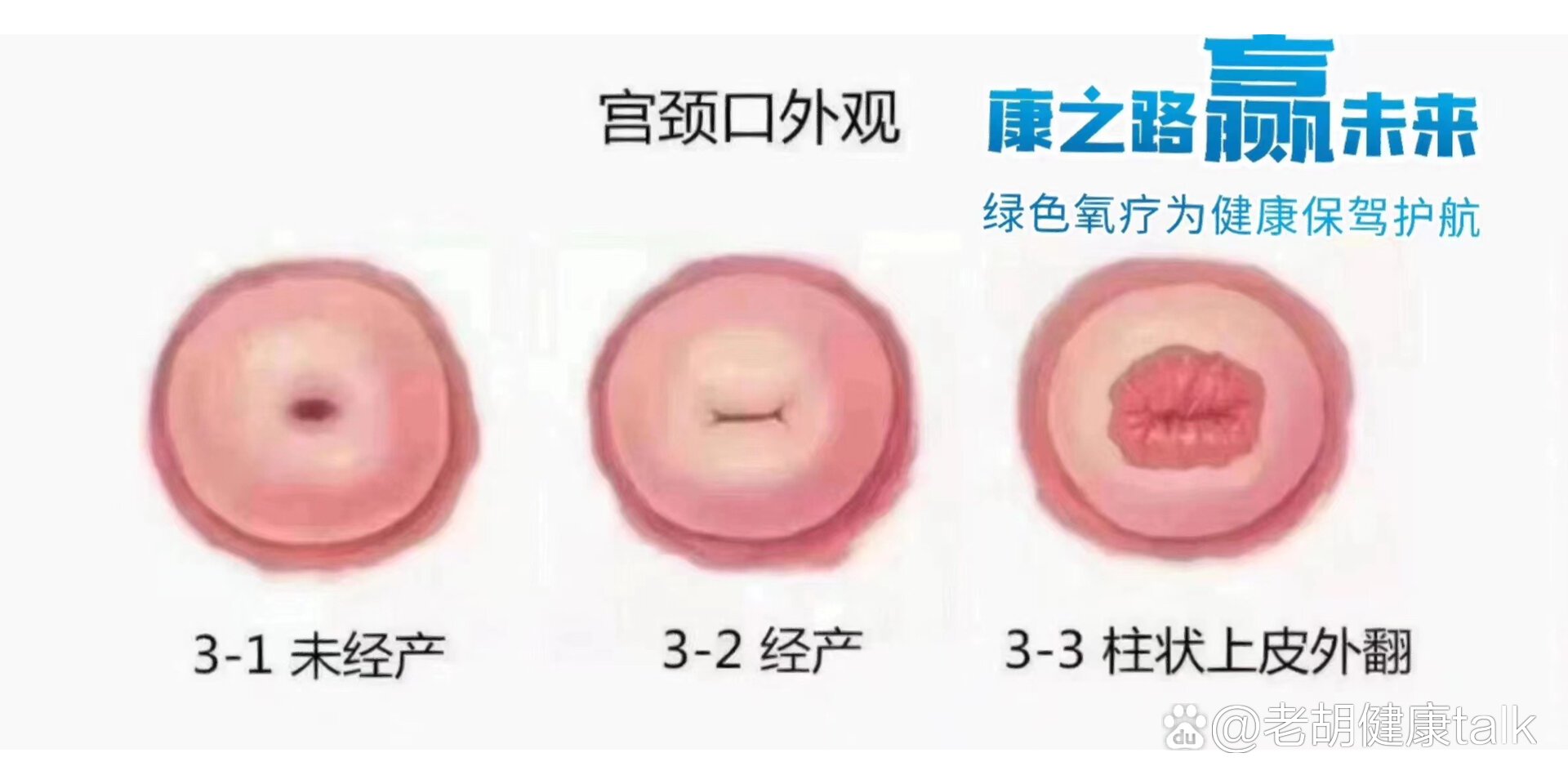 顺产后宫颈图片图片